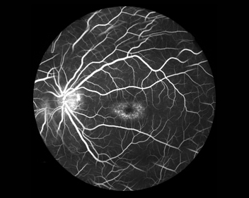 Angiofluoresceinografia da retina