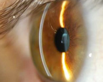 Biomicroscopia ocular