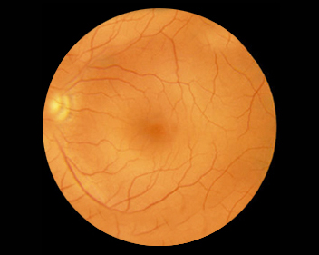 Mapeamento de retina
