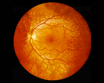 Retinografia do fundo do olho