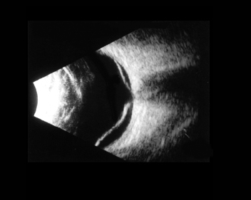 Ultrassonografia ocular