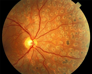 Laserterapia em retina
