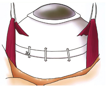 Retinopexia com introflexão escleral
