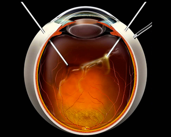 Ilustração de vitrectomia posterior